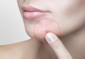 100% Pure Tea Tree Essential Oil